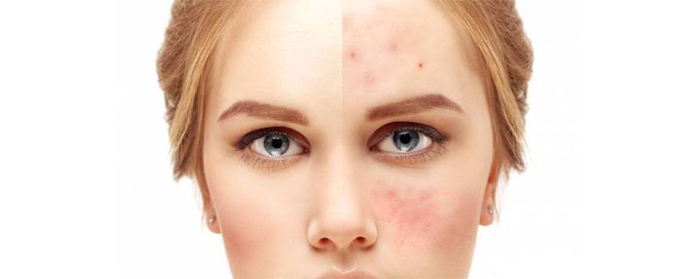 Reasons-pimples-face